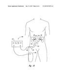 Methods and Apparatus for Multi-Vessel Renal Neuromodulation diagram and image