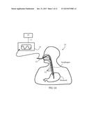 ESOPHAGEAL STIMULATION SYSTEM diagram and image