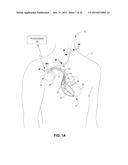 TECHNIQUES FOR PLACING MEDICAL LEADS FOR ELECTRICAL STIMULATION OF NERVE     TISSUE diagram and image