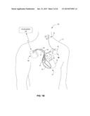 TECHNIQUES FOR PLACING MEDICAL LEADS FOR ELECTRICAL STIMULATION OF NERVE     TISSUE diagram and image