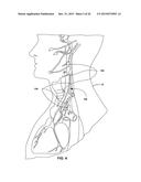 TECHNIQUES FOR PLACING MEDICAL LEADS FOR ELECTRICAL STIMULATION OF NERVE     TISSUE diagram and image