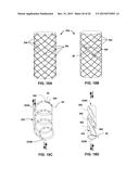 TECHNIQUES FOR PLACING MEDICAL LEADS FOR ELECTRICAL STIMULATION OF NERVE     TISSUE diagram and image