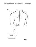 OPTICAL STIMULATION THERAPY diagram and image