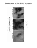 AUTOLOGOUS AND ALLOGENIC ADIPOSE-DERIVED STROMAL STEM CELL COMPOSITION FOR     TREATING FISTULAS diagram and image