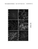 AUTOLOGOUS AND ALLOGENIC ADIPOSE-DERIVED STROMAL STEM CELL COMPOSITION FOR     TREATING FISTULAS diagram and image