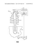 GAS TURBINE ENGINE COMPONENT EXTERNAL SURFACE MICRO-CHANNEL COOLING diagram and image