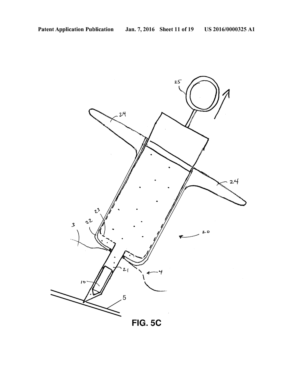 METHODS AND DEVICES FOR IMPLANTATION OF INTRAOCULAR PRESSURE SENSORS - diagram, schematic, and image 12