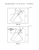 METHOD AND APPARATUS FOR ULTRASOUND NEEDLE GUIDANCE diagram and image