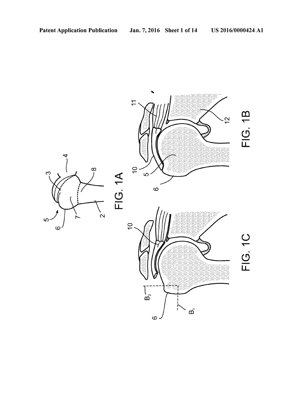 MEDICAL APPARATUS AND METHOD FOR ATTACHING A SUTURE TO A BONE - diagram, schematic, and image 02