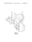 ADJUSTABLE FORCEPS FOR OSTEOSYNTHESIS CLIP diagram and image