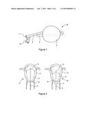 MEDICAL DEVICE FOR REDUCING BLEEDING diagram and image