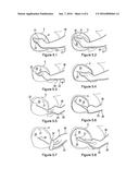 MEDICAL DEVICE FOR REDUCING BLEEDING diagram and image