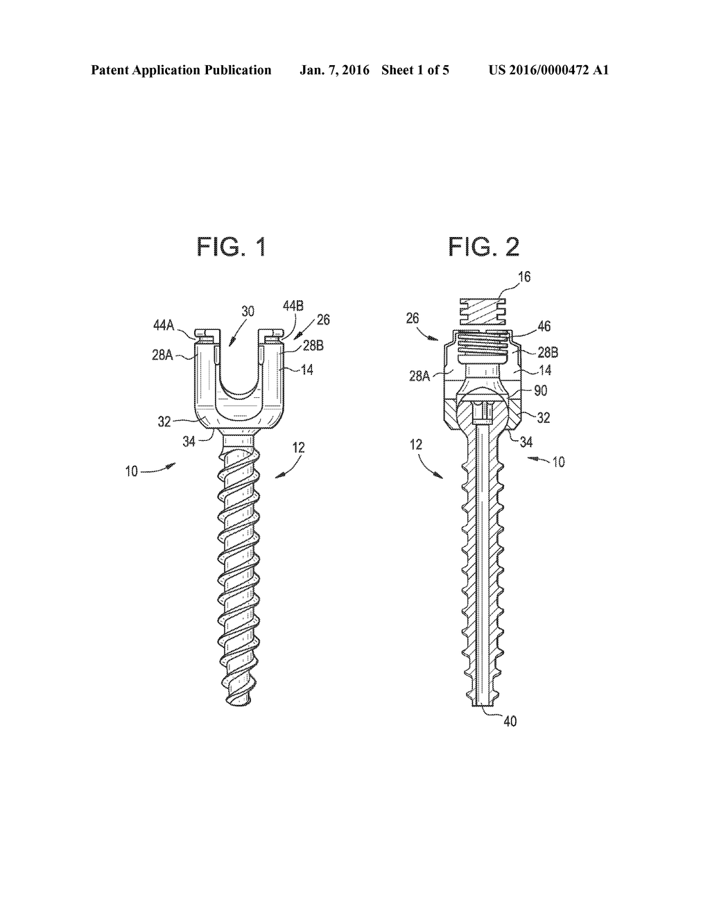 BONE ANCHORS - diagram, schematic, and image 02