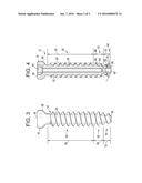 BONE ANCHORS diagram and image