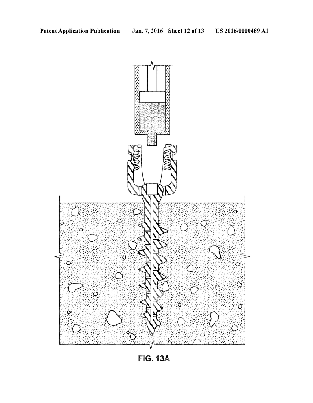 Composite Metal and Bone Orthopedic Fixation Devices - diagram, schematic, and image 13