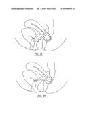 Intra-Vaginal Device For Fecal Incontinence diagram and image