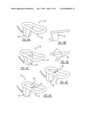 Intra-Vaginal Device For Fecal Incontinence diagram and image