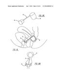 Intra-Vaginal Device For Fecal Incontinence diagram and image