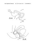 Intra-Vaginal Device For Fecal Incontinence diagram and image