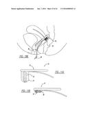 Intra-Vaginal Device For Fecal Incontinence diagram and image