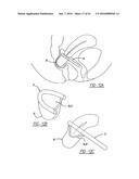 Intra-Vaginal Device For Fecal Incontinence diagram and image