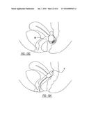 Intra-Vaginal Device For Fecal Incontinence diagram and image