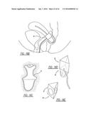 Intra-Vaginal Device For Fecal Incontinence diagram and image