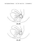 Intra-Vaginal Device For Fecal Incontinence diagram and image