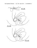 Intra-Vaginal Device For Fecal Incontinence diagram and image