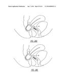 Intra-Vaginal Device For Fecal Incontinence diagram and image