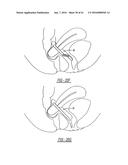 Intra-Vaginal Device For Fecal Incontinence diagram and image