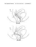 Intra-Vaginal Device For Fecal Incontinence diagram and image