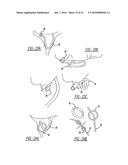 Intra-Vaginal Device For Fecal Incontinence diagram and image