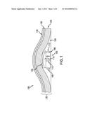 DEVICES, METHODS, AND SYSTEMS RELATED TO EXPANDABLE IMPLANTS diagram and image