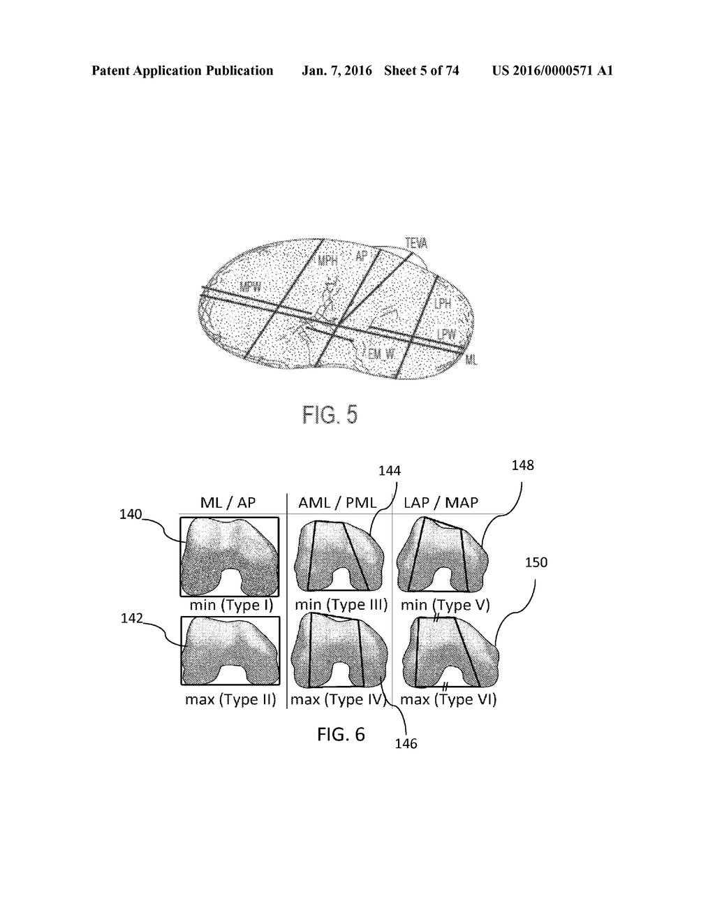 ETHNIC-SPECIFIC ORTHOPAEDIC IMPLANTS AND CUSTOM CUTTING JIGS - diagram, schematic, and image 06