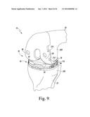 FEMORAL TRIAL COMPONENT diagram and image