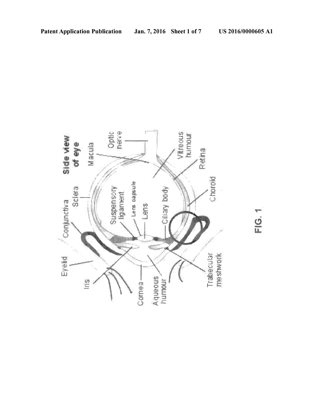 PRESBYOPIC VISION CORRECTION WITH CONTROLLED 3-D PATTERNED MECHANICAL     WEAKENING OF SCLERAL TISSUE - diagram, schematic, and image 02