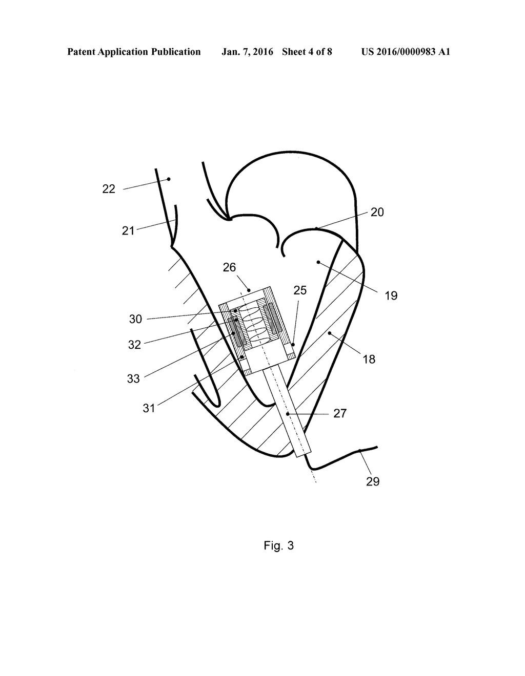 Ventricular assist device - diagram, schematic, and image 05