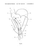 Ventricular assist device diagram and image