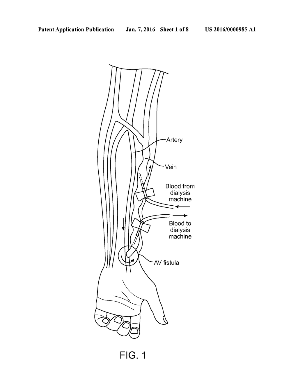 EXTRAVASCULAR DEVICES SUPPORTING AN ARTERIOVENOUS FISTULA - diagram, schematic, and image 02