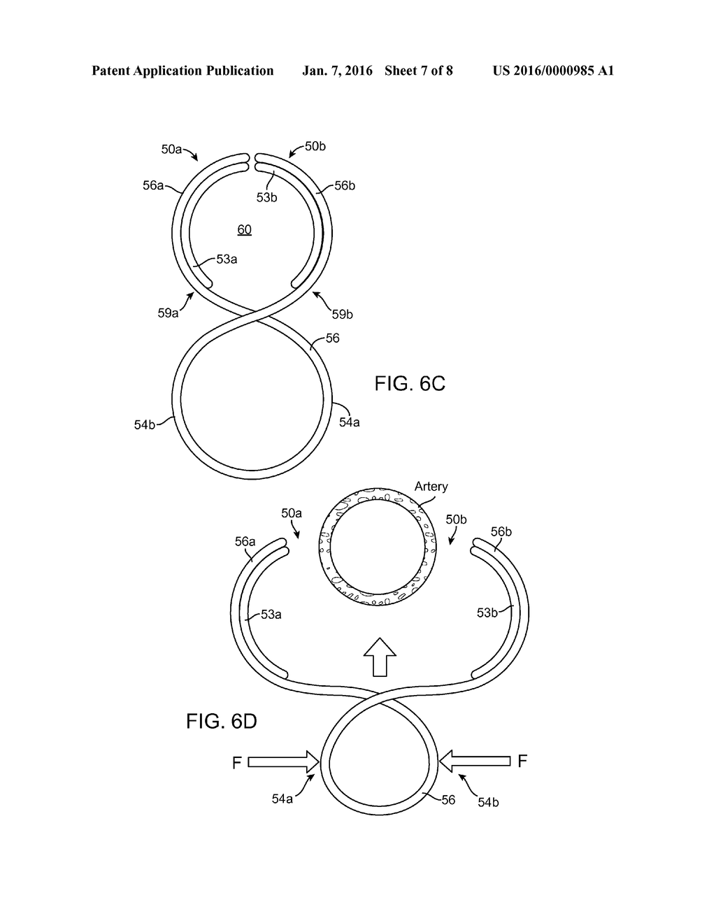 EXTRAVASCULAR DEVICES SUPPORTING AN ARTERIOVENOUS FISTULA - diagram, schematic, and image 08