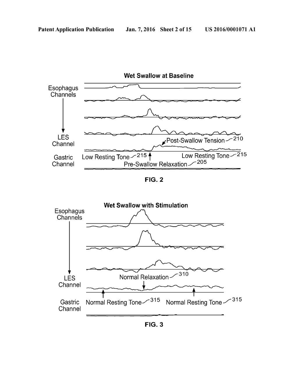 Device and Implantation System for Electrical Stimulation of Biological     Systems - diagram, schematic, and image 03