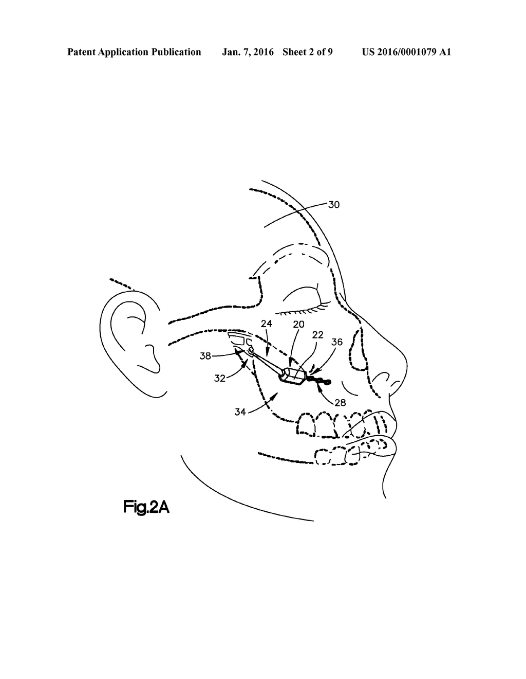 NEUROSTIMULATOR SYSTEM, APPARATUS AND METHOD FOR CONDUCTING A CLINICAL     TRIAL - diagram, schematic, and image 03