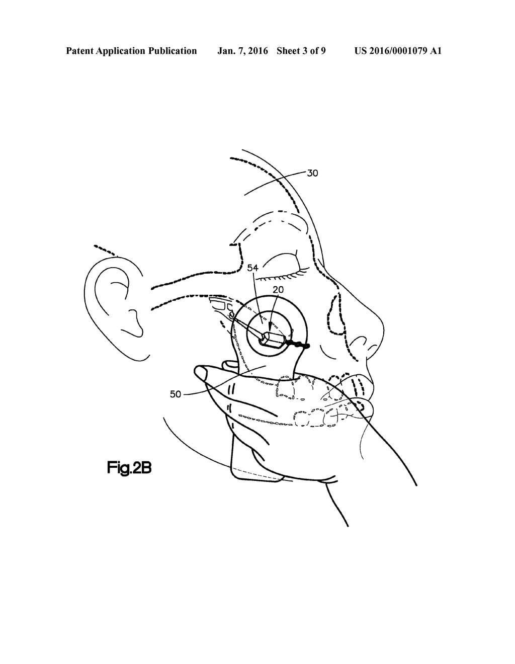 NEUROSTIMULATOR SYSTEM, APPARATUS AND METHOD FOR CONDUCTING A CLINICAL     TRIAL - diagram, schematic, and image 04