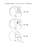 SYSTEMS, METHODS AND DEVICES FOR A SKULL/BRAIN INTERFACE diagram and image