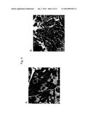 FHL1 MUTATIONS ASSOCIATED WITH NOVEL X-LINKED MUSCULAR MYOPATHIES diagram and image