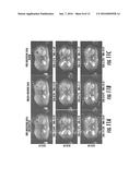 MRI WITH REPEATED K-T -SUB-SAMPLING AND ARTIFACT MINIMIZATION ALLOWING FOR     FREE BREATHING ABDOMINAL MRI diagram and image