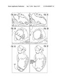 COMPUTATIONAL FLOW DYNAMICS BASED METHOD FOR STIMATING THROMBOEMBOLIC RISK     IN PATIENTS WITH MYOCARDIAL INFARCTION diagram and image