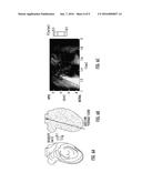 COMPUTATIONAL FLOW DYNAMICS BASED METHOD FOR STIMATING THROMBOEMBOLIC RISK     IN PATIENTS WITH MYOCARDIAL INFARCTION diagram and image