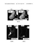 COMPUTATIONAL FLOW DYNAMICS BASED METHOD FOR STIMATING THROMBOEMBOLIC RISK     IN PATIENTS WITH MYOCARDIAL INFARCTION diagram and image